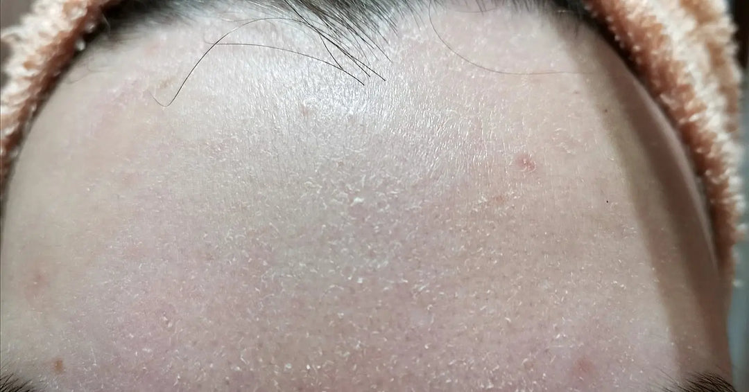 DRY SKIN - Timeless Beauty