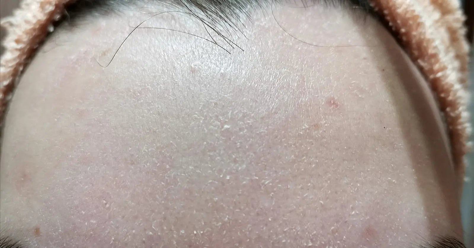 DRY SKIN - Timeless Beauty