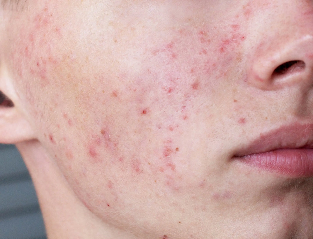 Acne