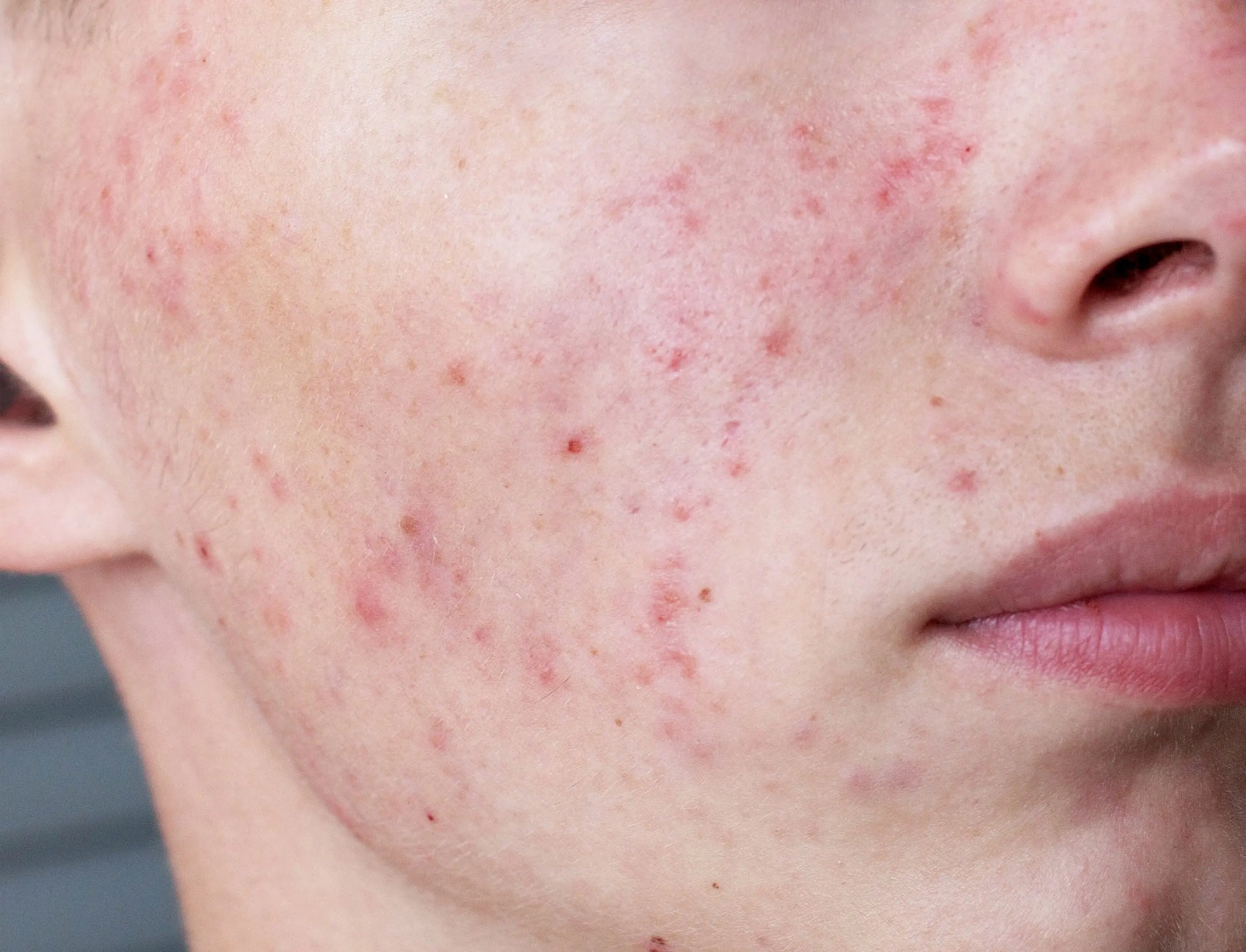 Acne