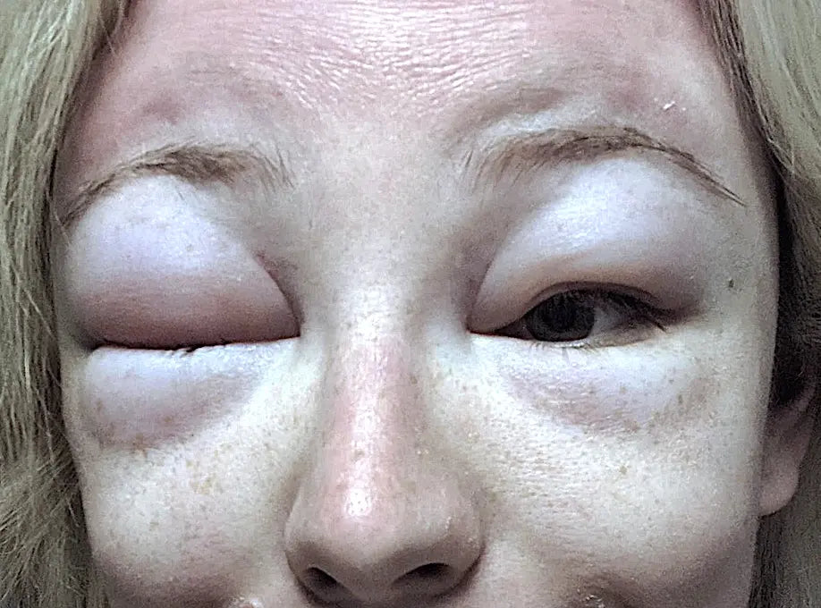 Facial Swelling