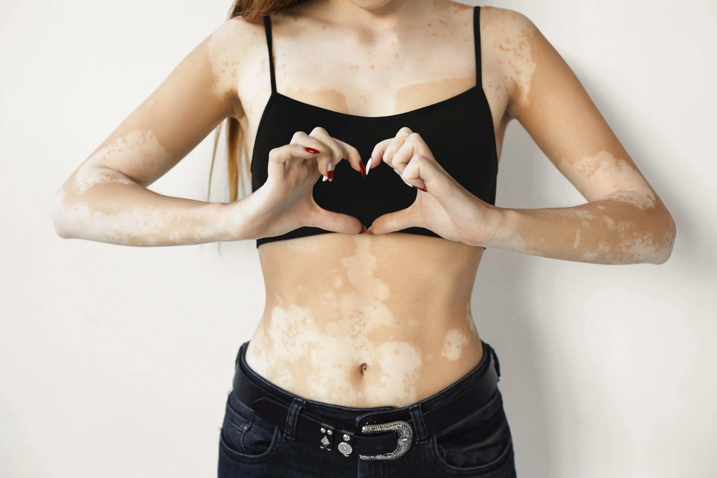 Skin Conditions