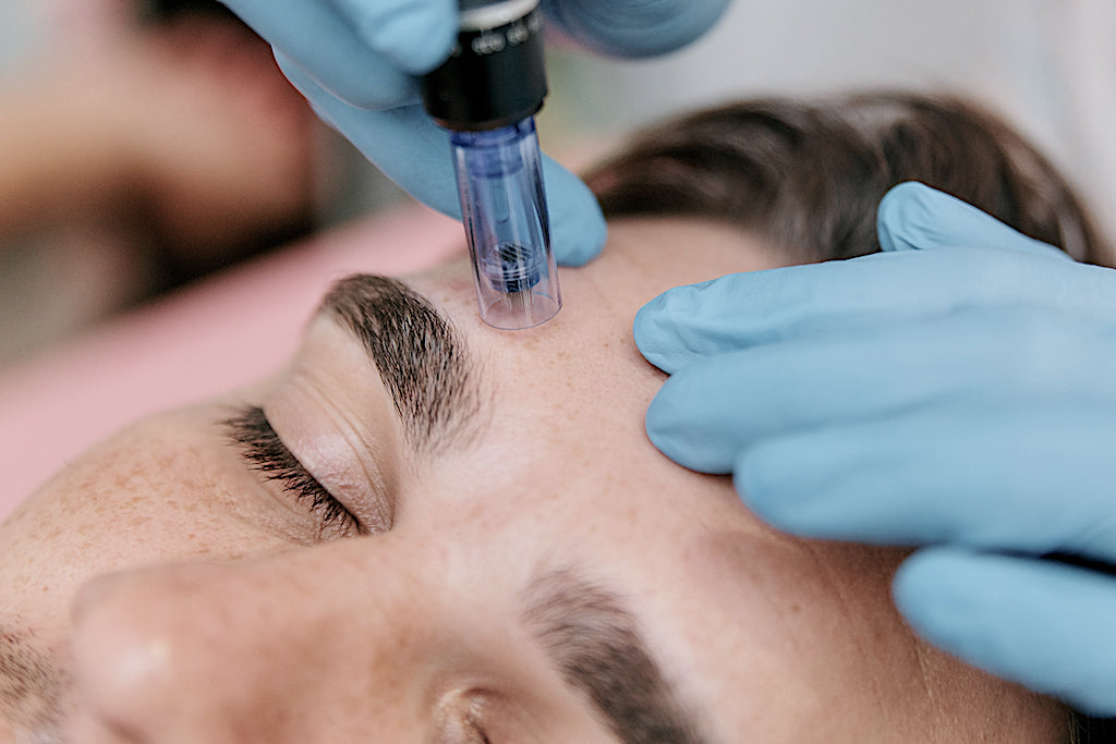 Quantum Glow: Microneedling & Carboxy CO2 Treatment