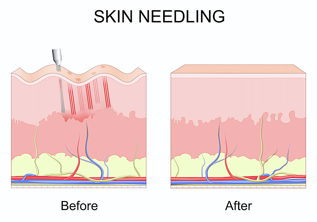 Microneedling