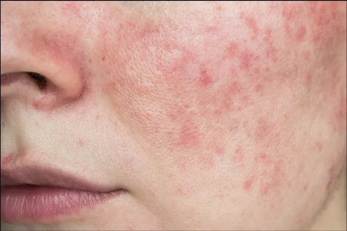 ROSACEA