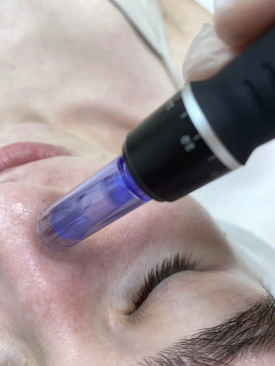 Dermapen Microneedling Timeless Beauty