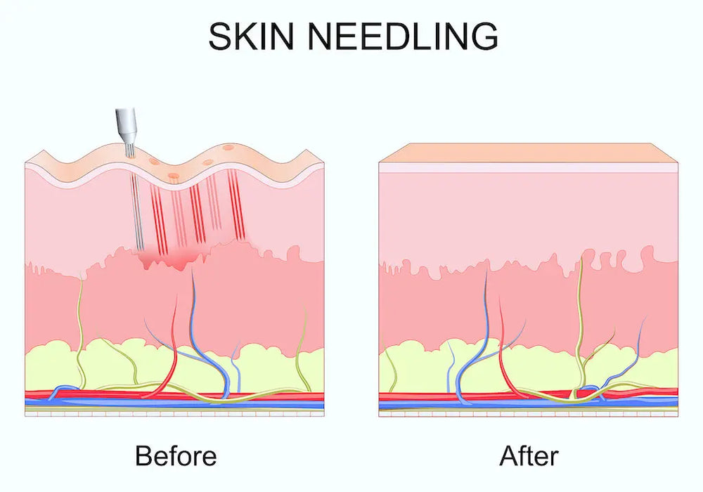 Dermapen Microneedling Timeless Beauty